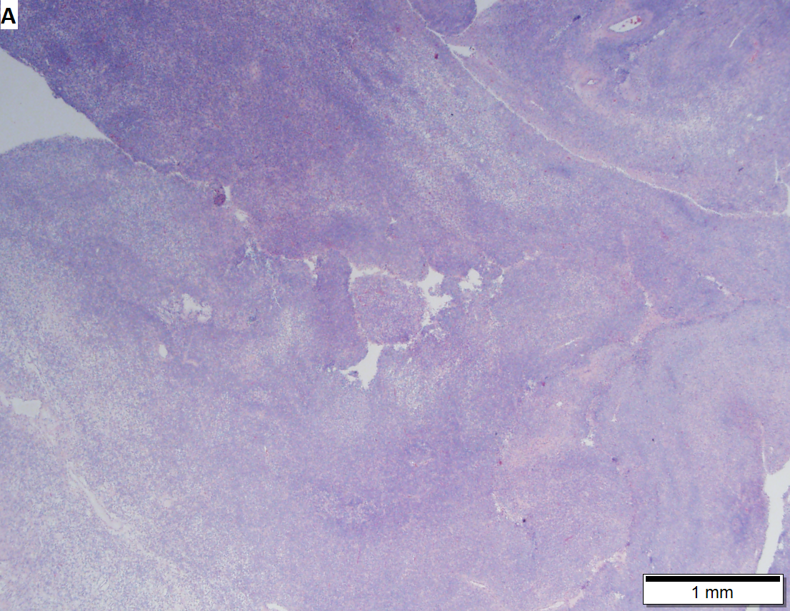 Granulosa cell tumor.