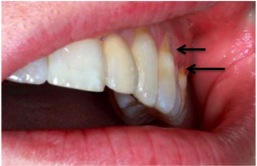 File:Abfraction.jpg