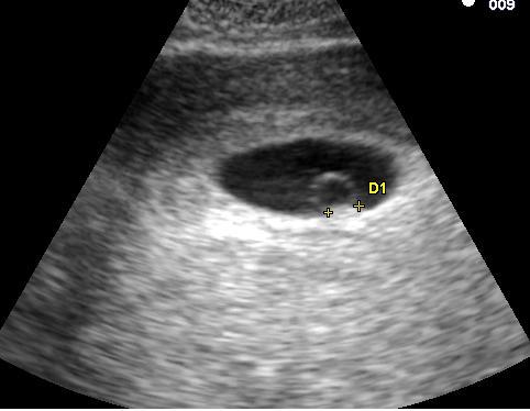 Embryo_at_5_weeks