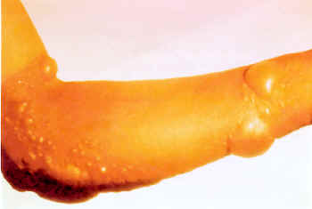 File:Blister-arm.jpg