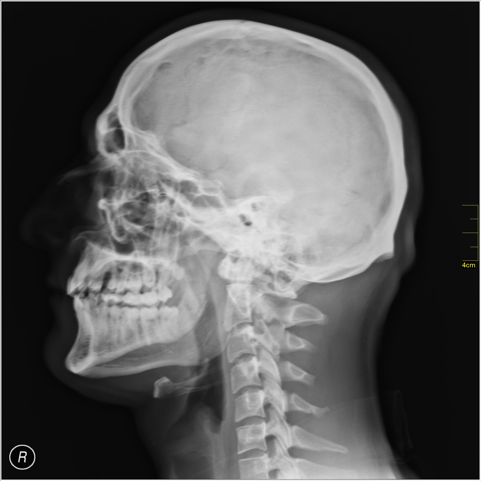 Medical X-Ray imaging PCM06 nevit.jpg English: Roentgenogram or Medical X-ray image. May not be to scale. Date 2011 Source Own work Author