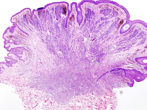 File:Nevocellular nevus histopathology (1).jpg