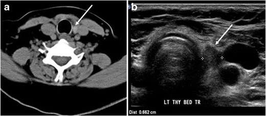 Fig. 7. A 51-year-old female patient post total thyroidectomy for PTC with elevated thyroglobulin measurement. an Axial non-enhanced CT scan of the neck at the level of the thyroid bed demonstrates a well-defined, rounded, homogenously dense soft tissue situated between the trachea and left internal jugular vein (white arrow). b Transverse ultrasound image of the neck demonstrates a well-defined, homogeneous, hypoechoic soft tissue nodule measuring 6 mm (white arrow) with no detected micro-calcifications. Biopsy showed a predominantly residual normal thyroid tissue with micro-foci of PTC.[1]