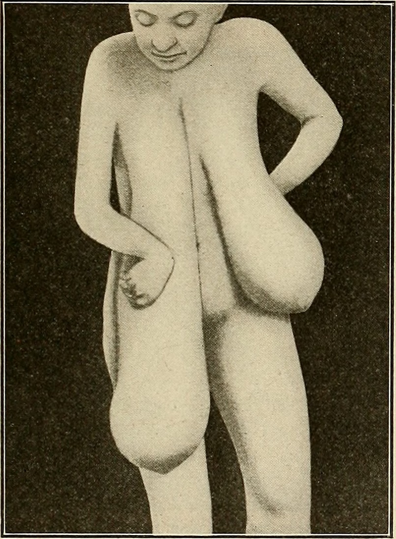 File:Breast reconstruction (4).jpg - Wikimedia Commons