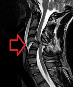 <span class="mw-page-title-main">Neurogenic shock</span> Insufficient blood flow due to autonomic nervous system damage