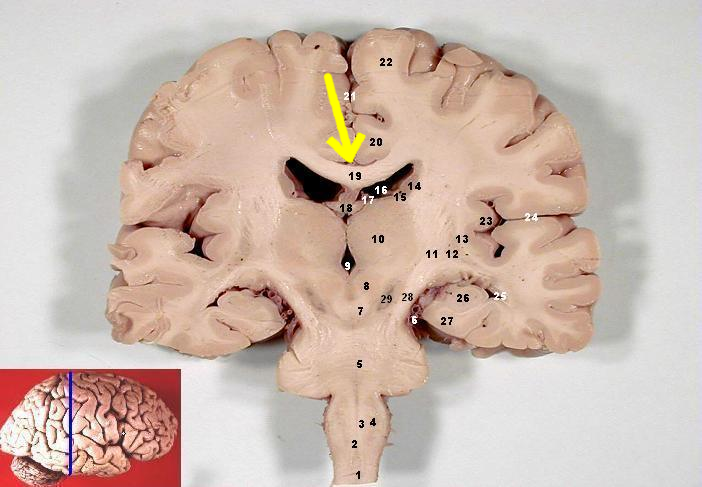 File:Human brain frontal (coronal) section description 2-emphasizing-corpus-callosum.png