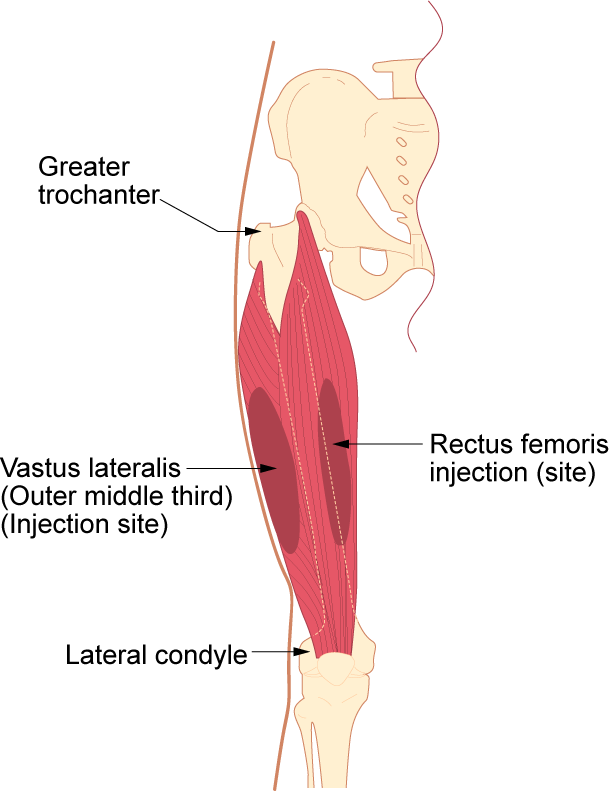 vastus lateralis injection