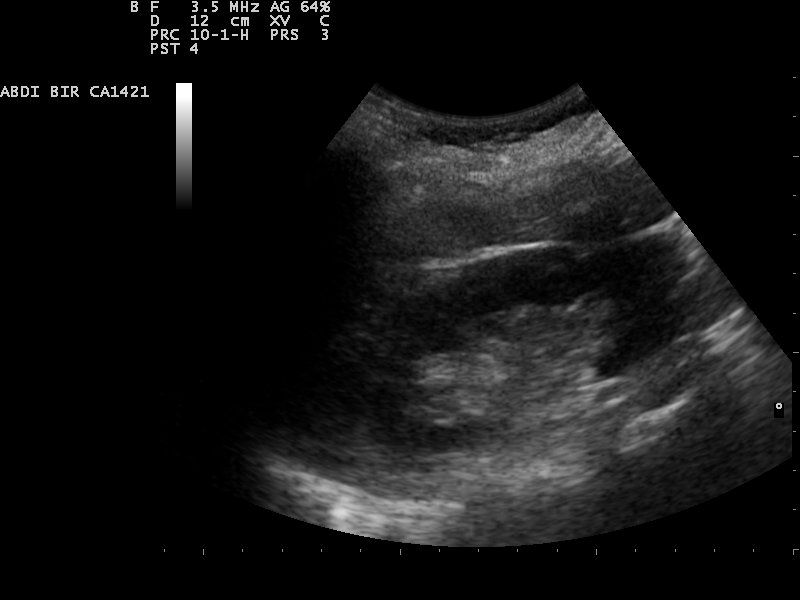 File:Kidney ultrasound 110329145526 1457090.jpg