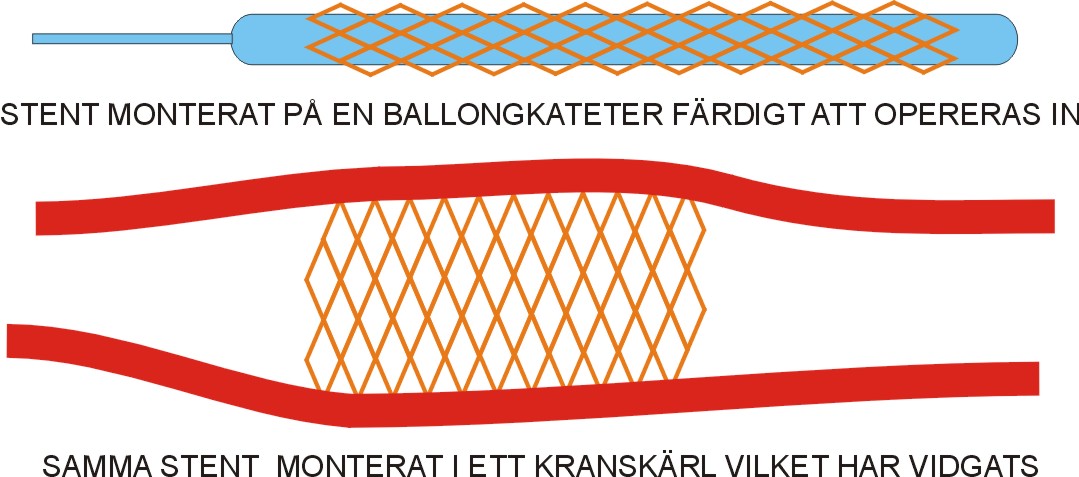 Urinledare förträngning