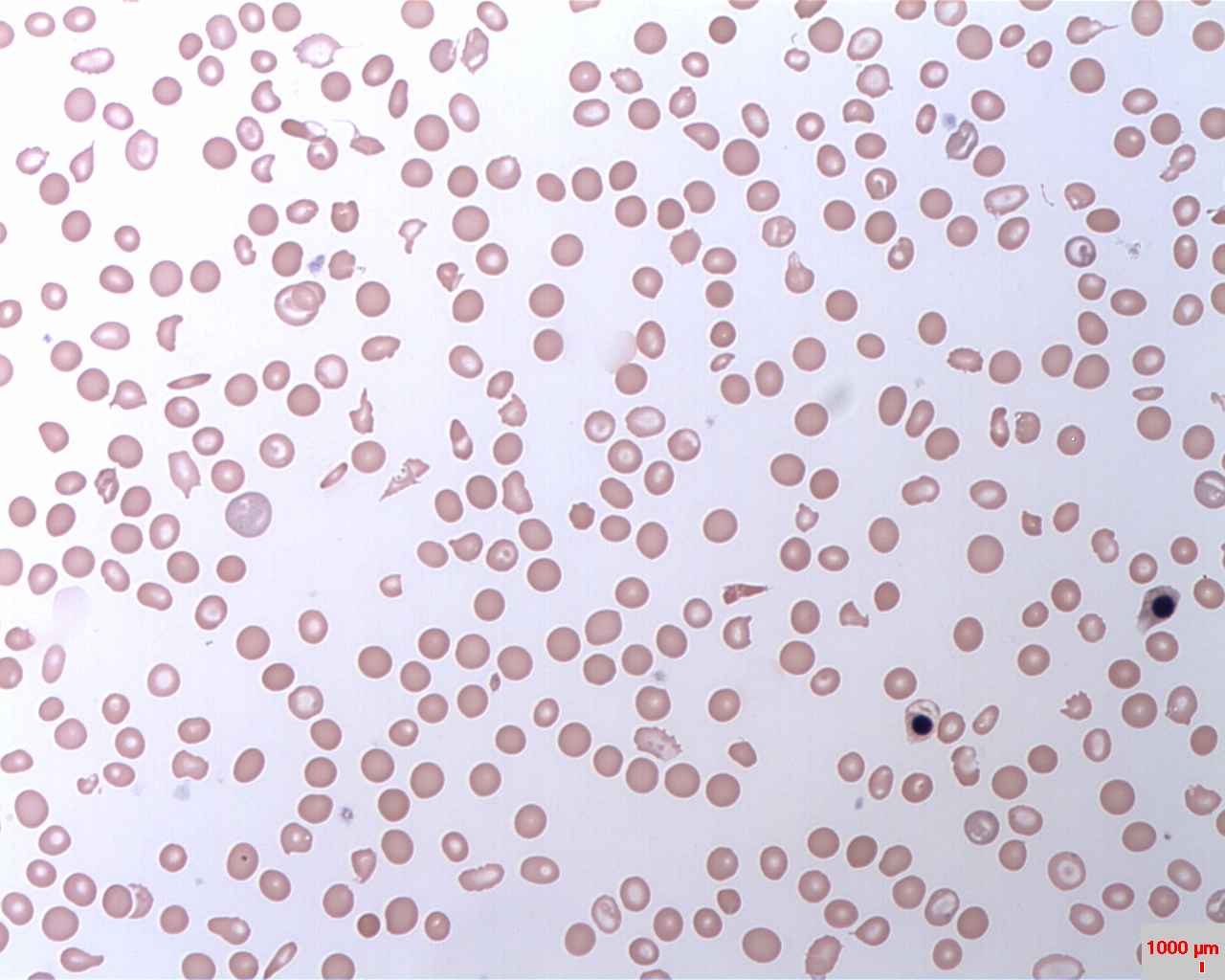 Paroxysmal Nocturnal Hemoglobinuria Wikipedia