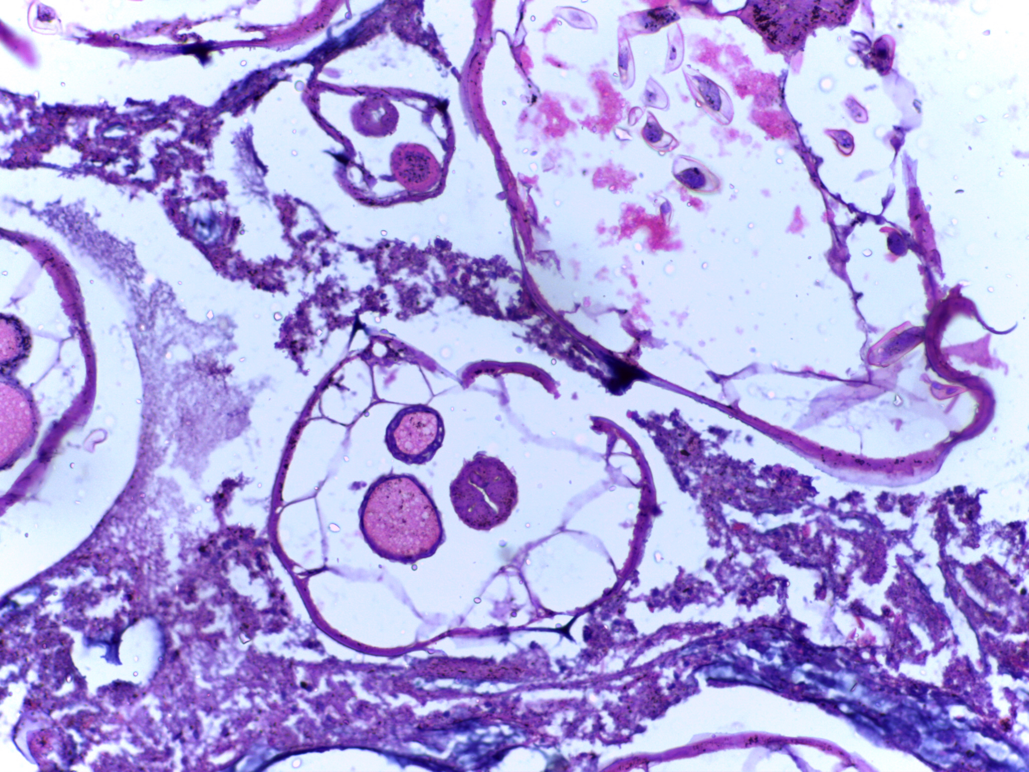 helminthiasis icd 10