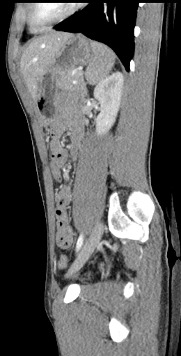 CT of a normal abdomen and pelvis, sagittal plane 114.png
