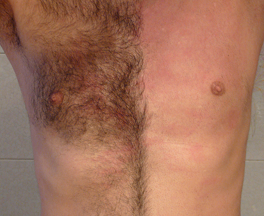 A comparison photo of a males chest waxing