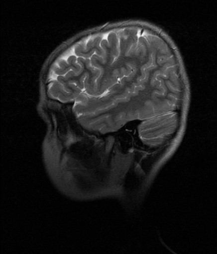 File:Anaplastisches Ependymom - MRT - T2 sagittal - 019.jpg