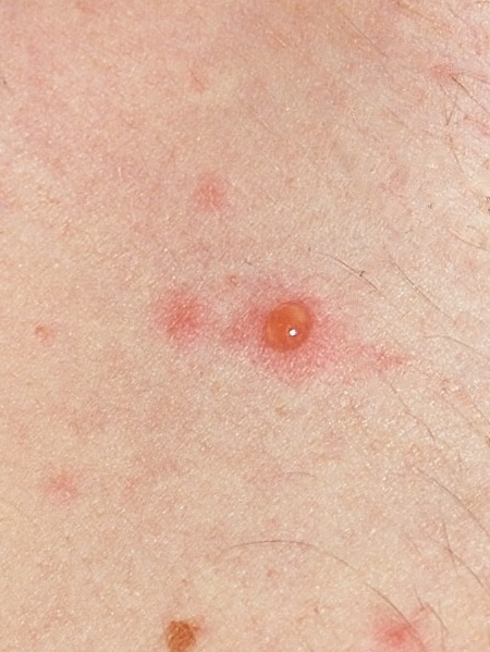 File:Chickenpox blister.jpg