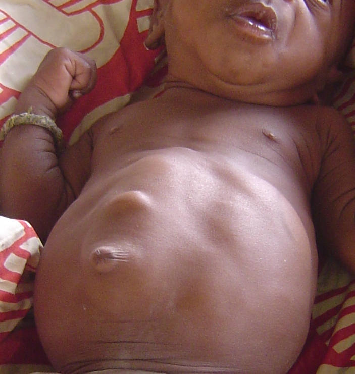 Protuberant Abdomen Infant