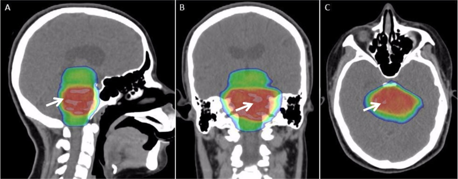 Palliative Care Options for a Young Adult Patient with a Diffuse Intrinsic Pontine Glioma - Fig. 3.png