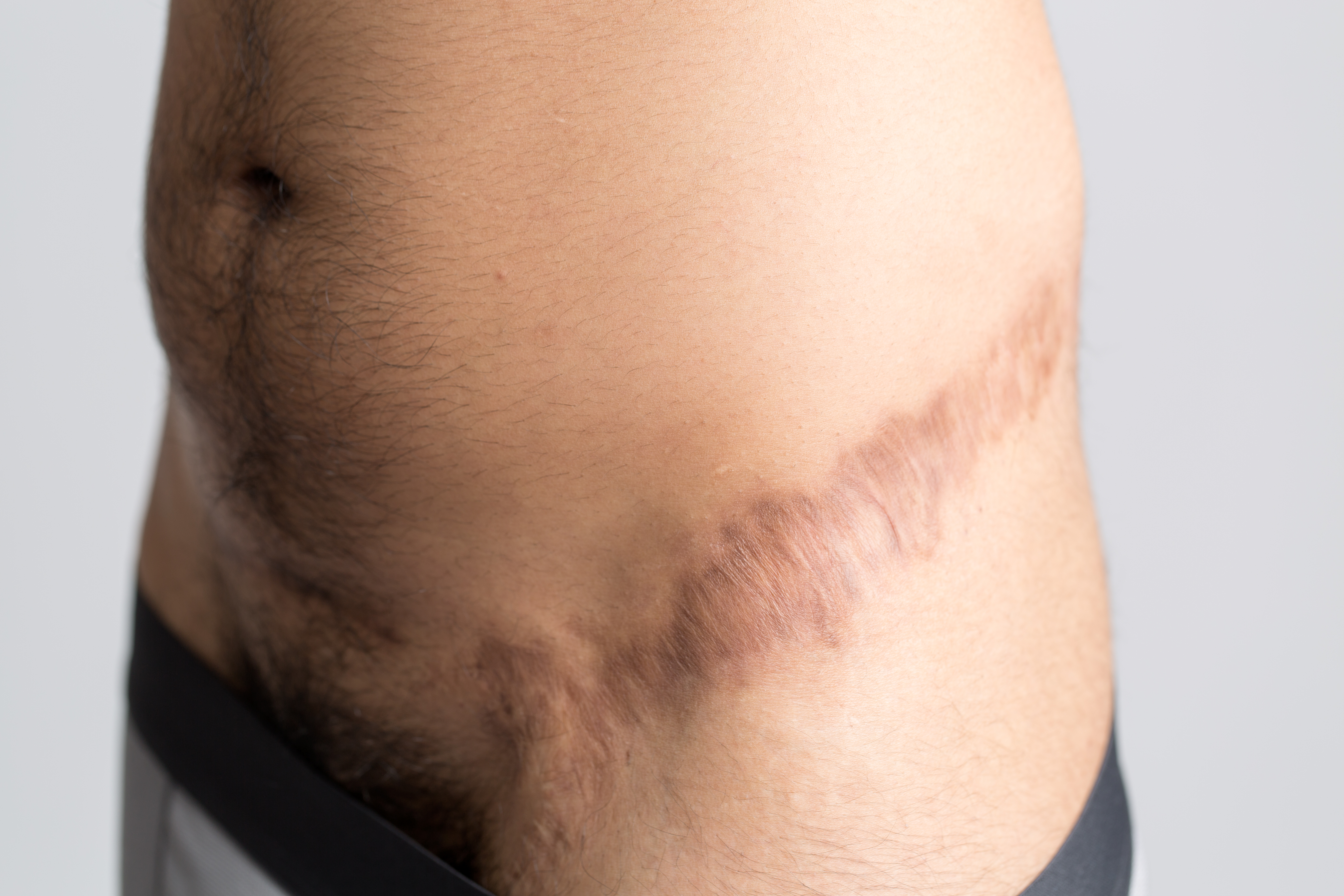 Sex reassignment scar on hip.jpg English: Alexander, 30 years old Wikimedia Sverige Date 6 July 2016, 14:57:10 Source Private collection institution