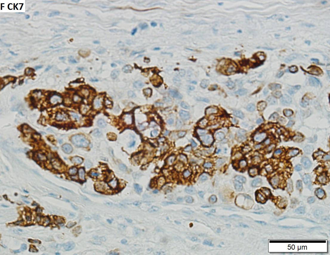 High grade urothelial carcinoma