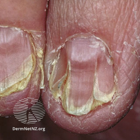 Psoriasis of the Nails | Treatment & Management | Point of Care