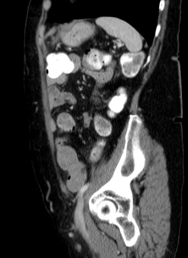 File:Hufeisenniere 04 - CT - sagittal - 039.jpg