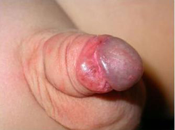 File:Multiple pyogenic granuloma 01.jpg