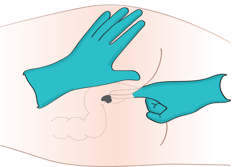 File:Administering-med-rectally-2.png