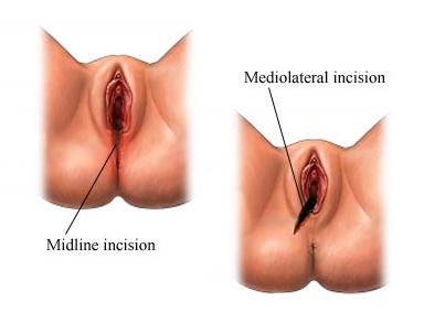 File:Vaginaepisiotomy.jpg