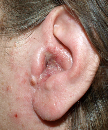 Otitis externa Wikipedia