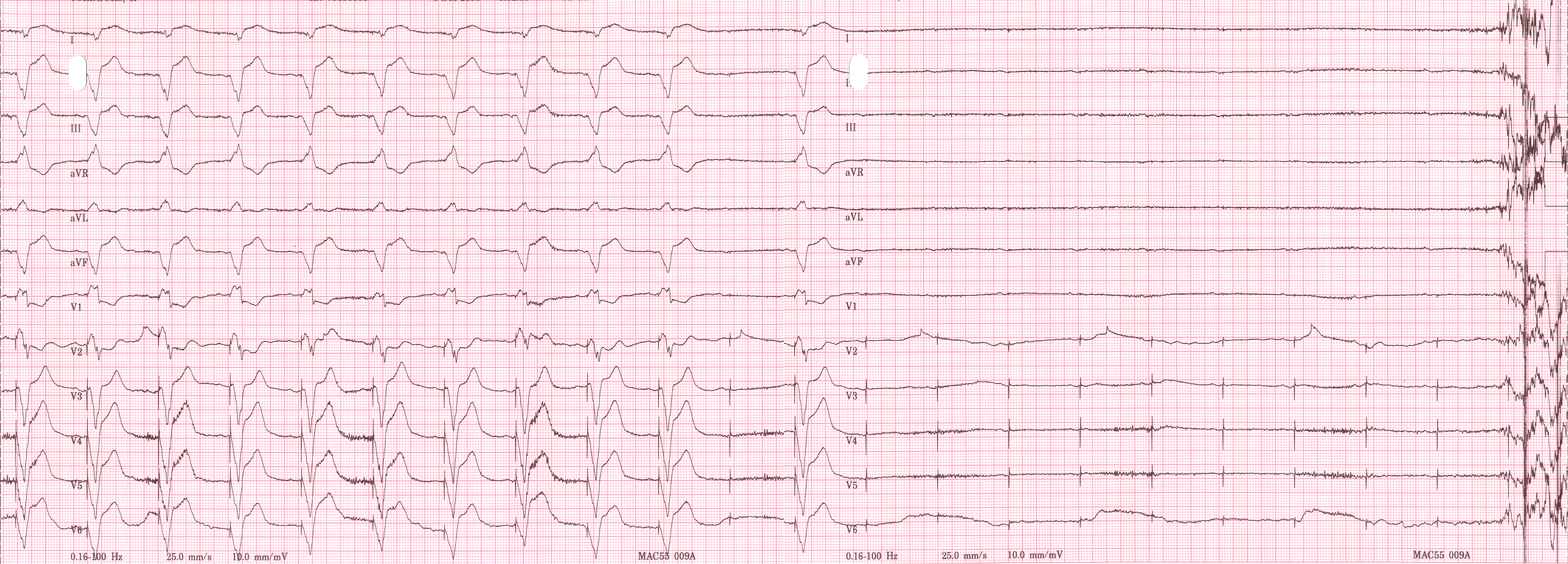 File Pacemaker Dependent Asystole Jpg Wikimedia Commons