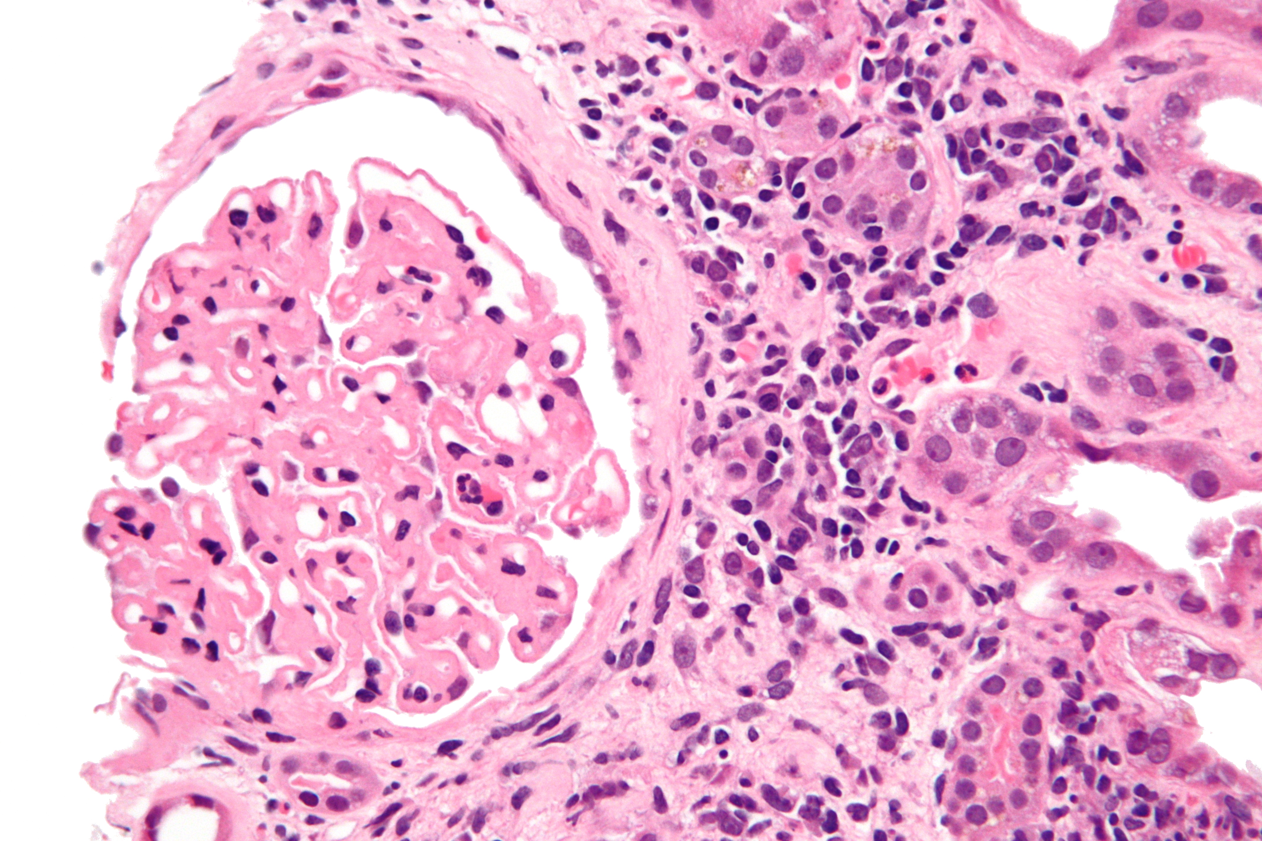 Membranous_nephropathy_ _he_ _very_high_mag