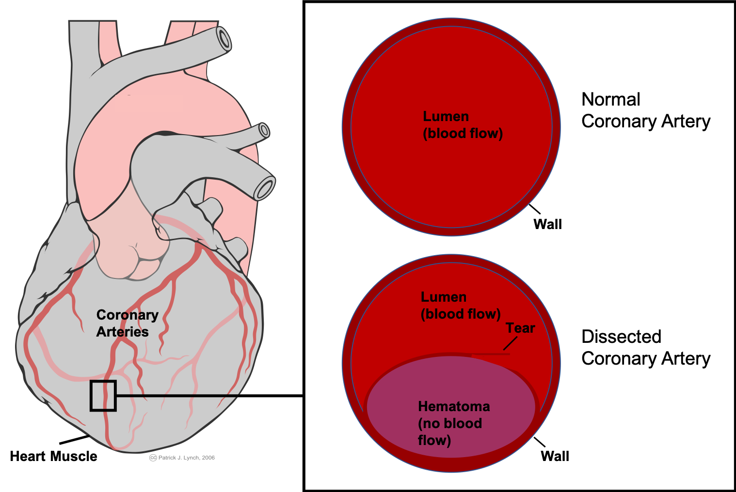 Study Reveals Underlying Genetic Risks for a Type of Heart Attack Largely Affecting Younger Women