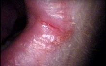 Angular cheilitis – a fissure running in the corner of the mouth with reddened, irritated facial skin adjacent