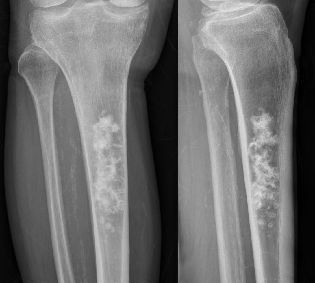 File:Enchondrom Tibia 83jm - Roe ap und seitlich - 001.jpg - Wikimedia  Commons