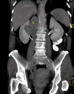 File:CT-Nierentumor-rechts.jpg