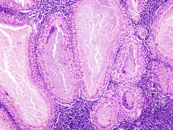 warthin's tumor histology Segíti a méz segítséget a prostatitisből