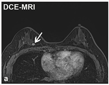 Breast - Wikipedia