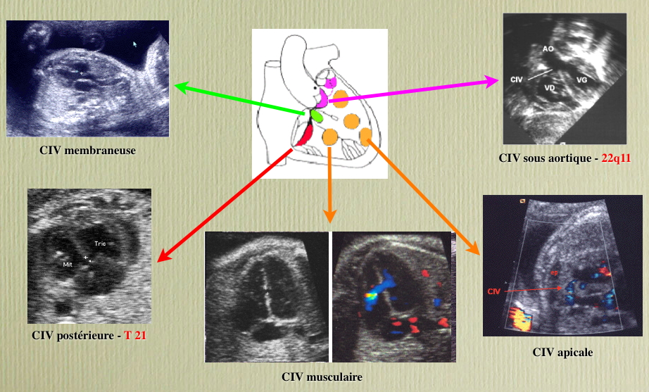 CIVFoetus-Wiki.jpg