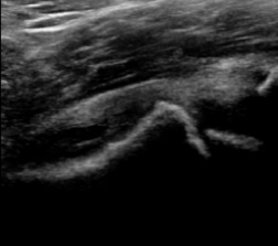 Step in the femoral head-neck junction in a patient with SCFE.