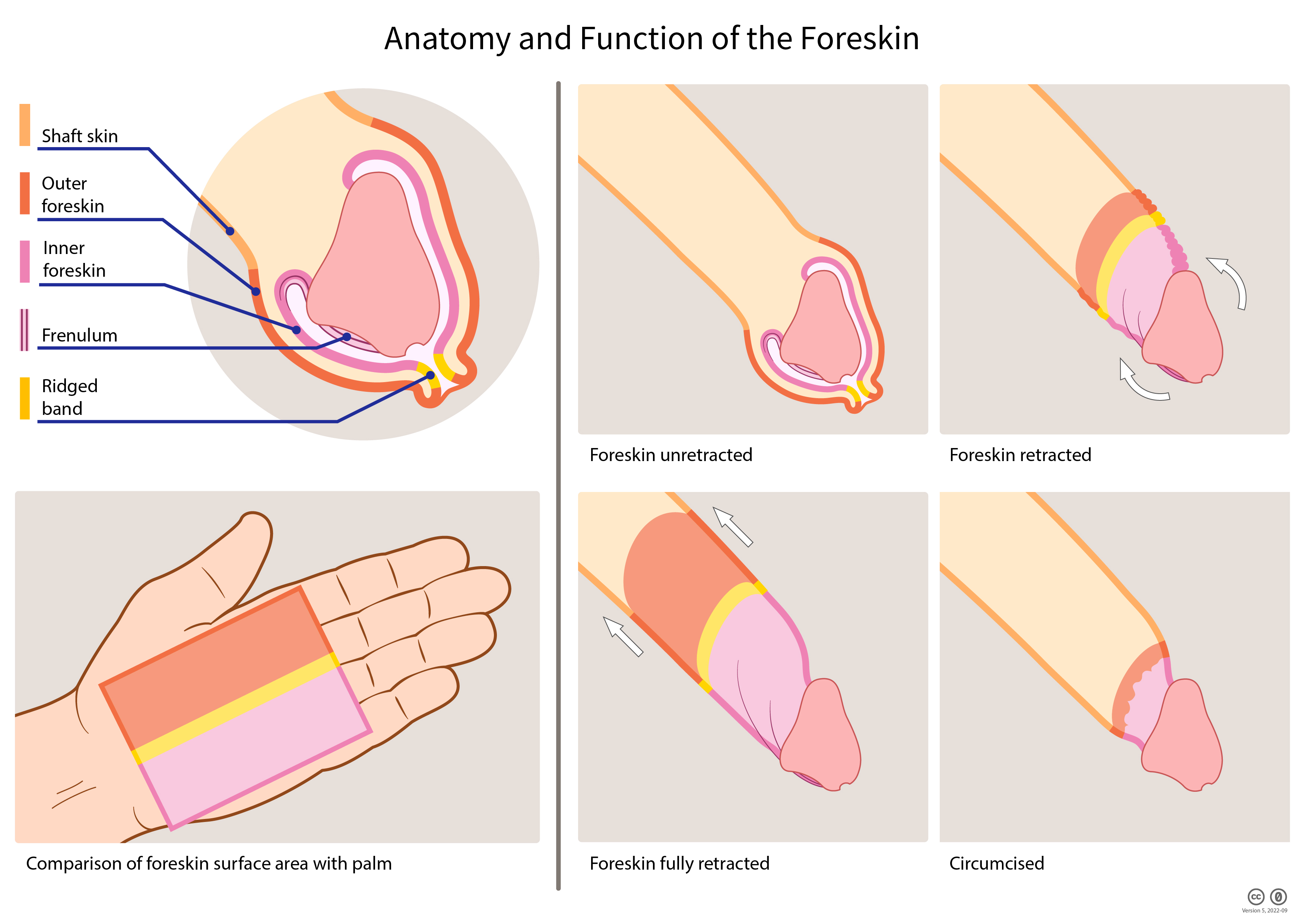 a–b Foreskin retraction in CMP. a Foreskin retraction reveals