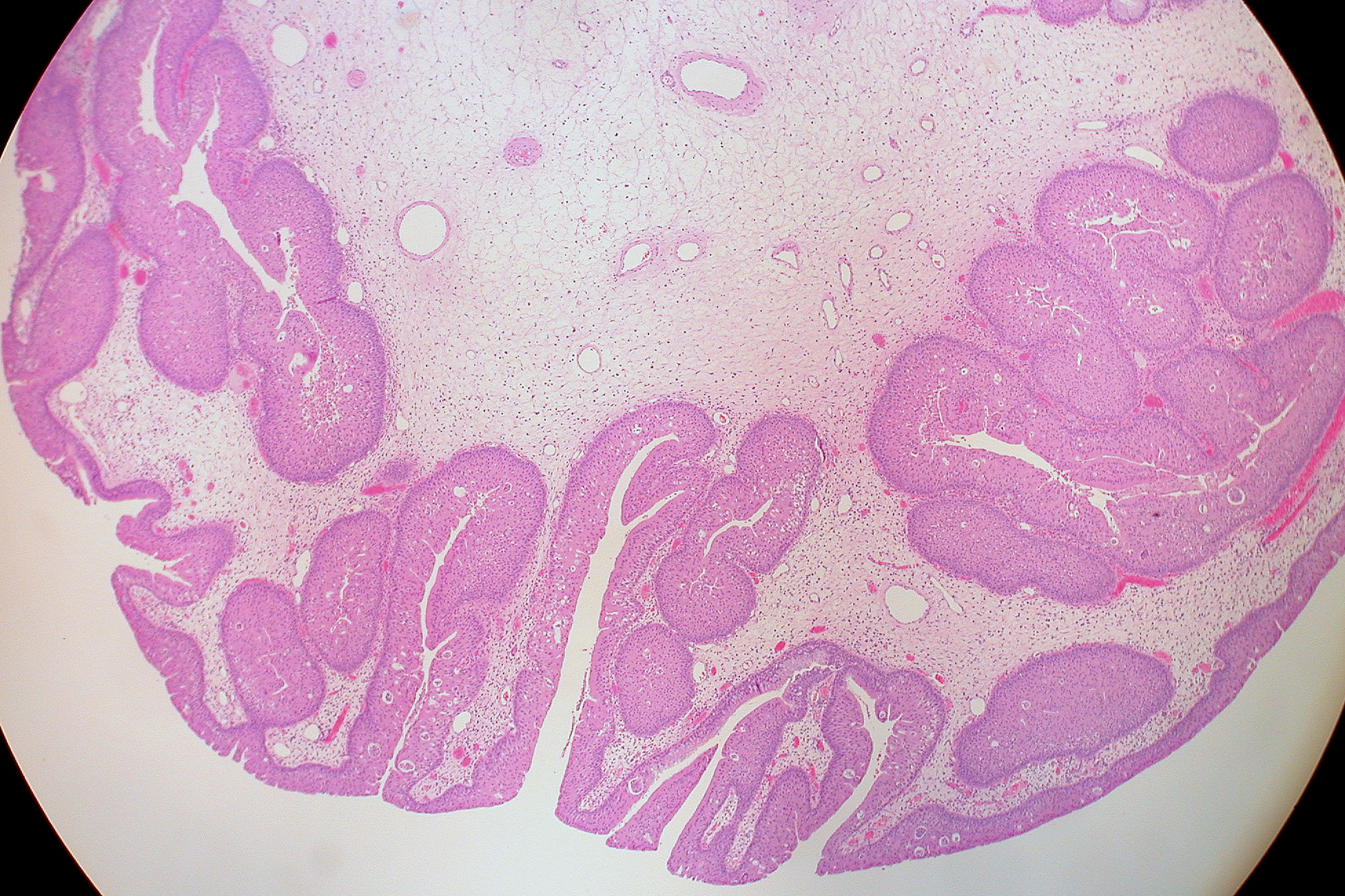 oncocytic papilloma nasal)