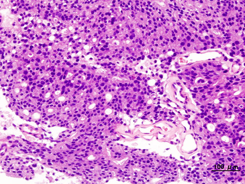 File:Prostatic adenocarcinoma Gleason pattern 4.JPG