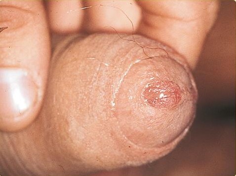 File:SOA-non specific Urethritis-male.jpg