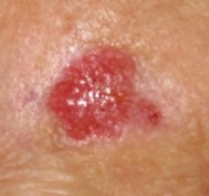 English: Skin cancer of the check. Query basal...