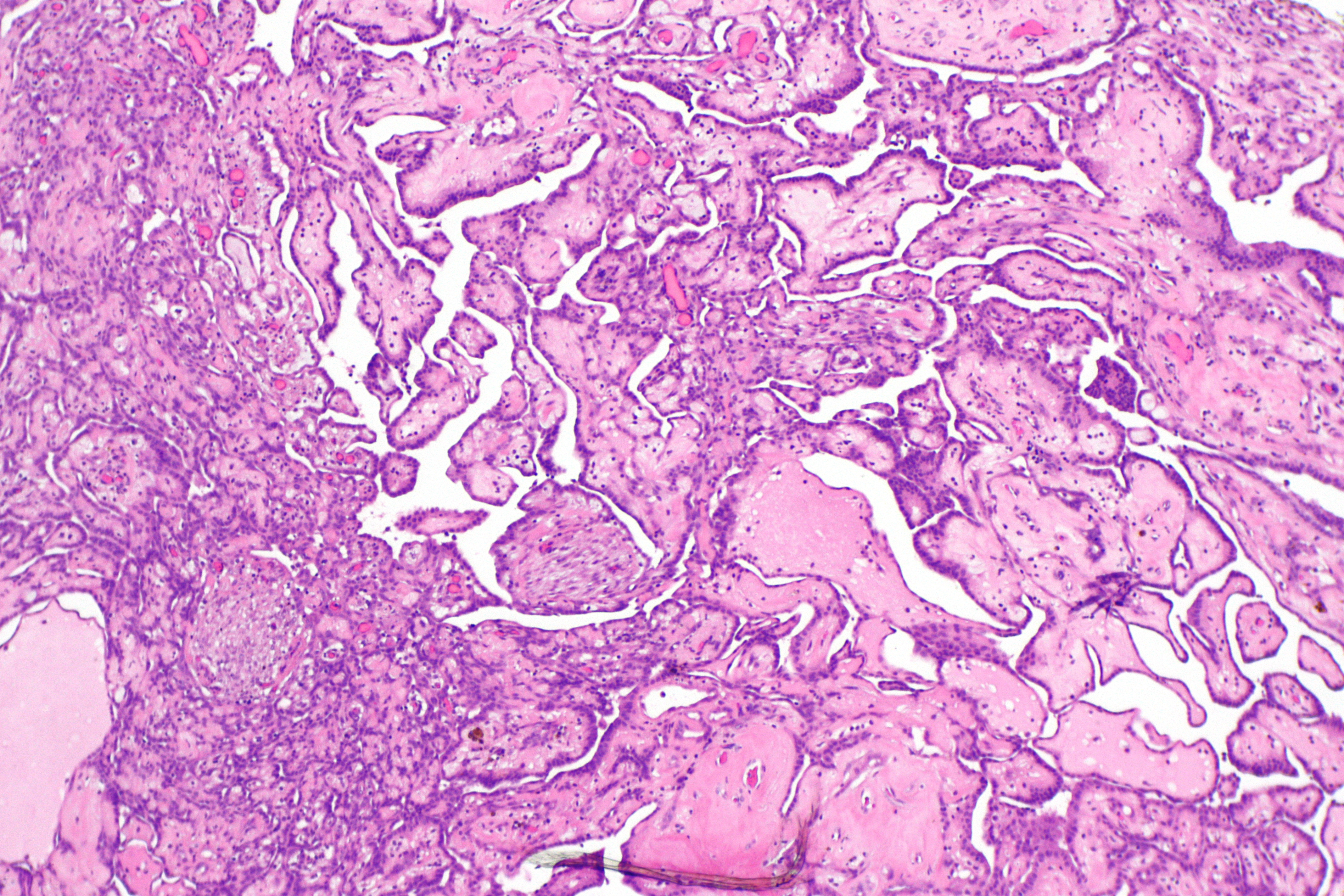 mesothelioma mesotheliomaelioma meaning