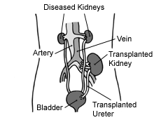 File:Kidtransplant.gif