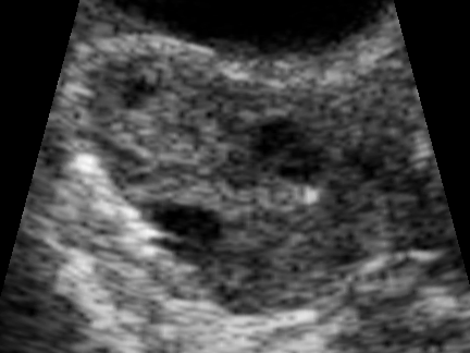 File:Ultrasound Scan ND 0112115321 1156340.png