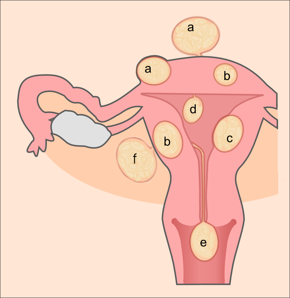 File Uterine Fibroids Png Wikimedia Commons