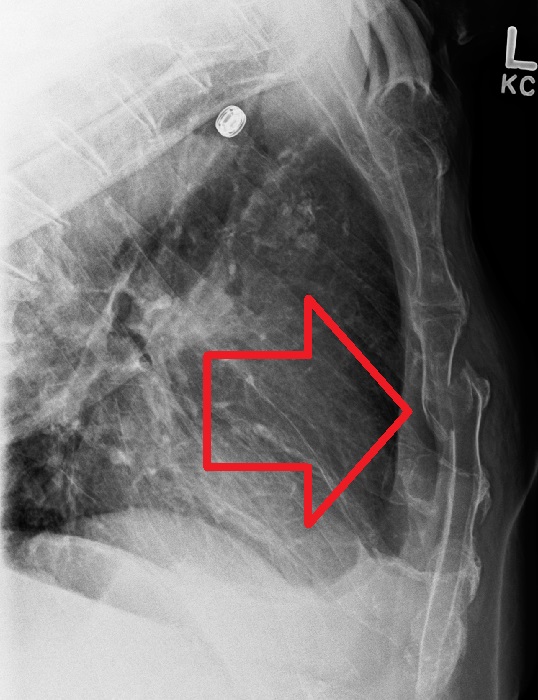 Sternal fracture - Wikipedia