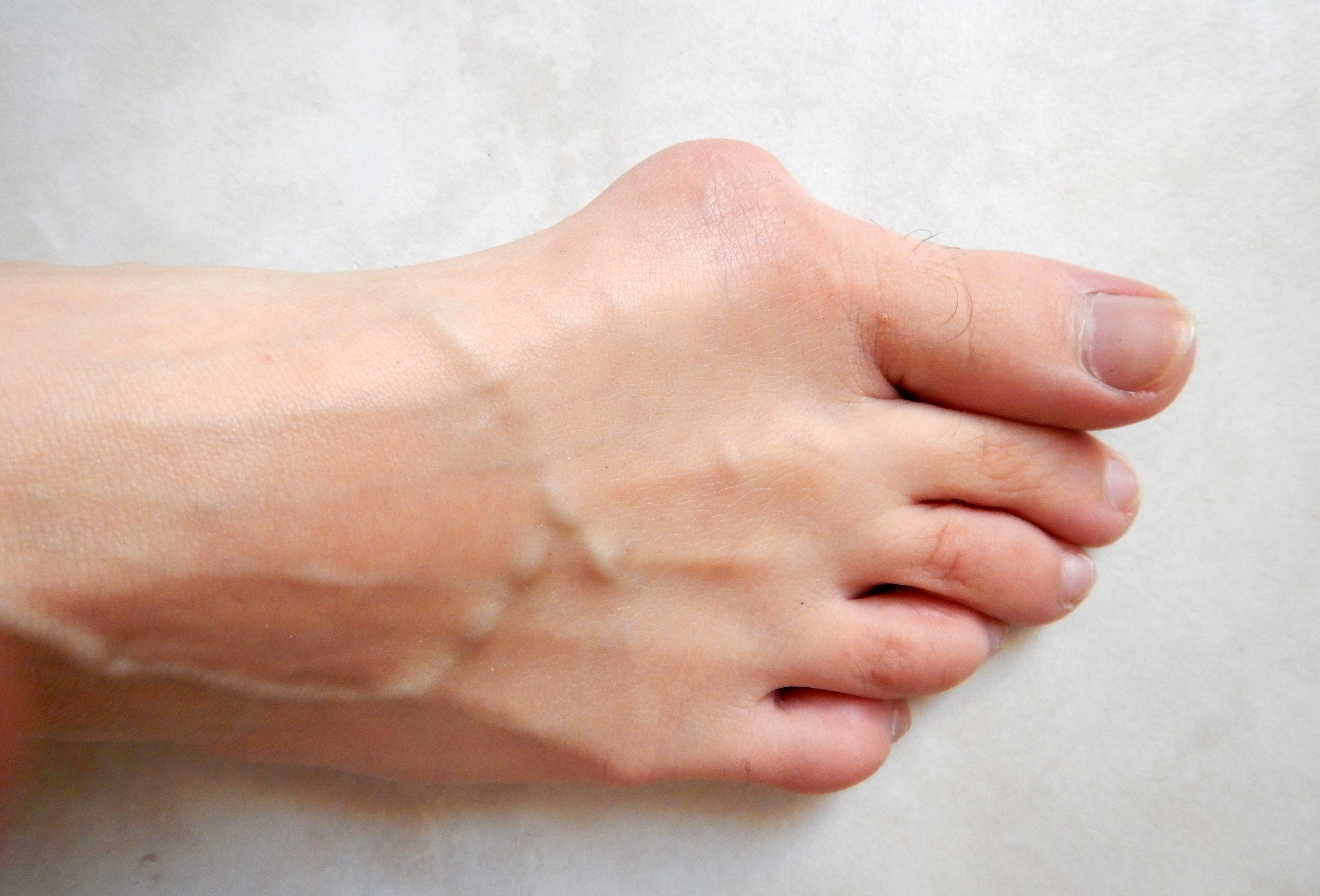 10 Bunion Exercises To Prevent Foot Pain